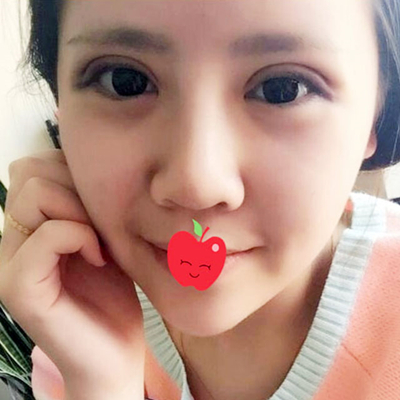 中加科洋做埋線雙眼皮一個(gè)月了，分享術(shù)后果照片~