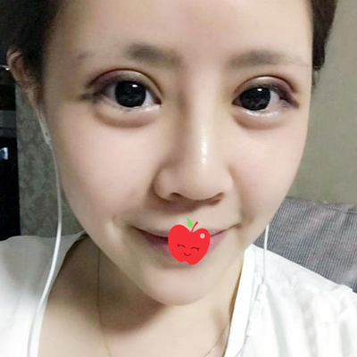 中加科洋做埋線雙眼皮一個(gè)月了，分享術(shù)后果照片~