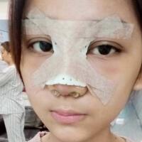 隆鼻整形恢復(fù)日記分享，整形價(jià)格8800元