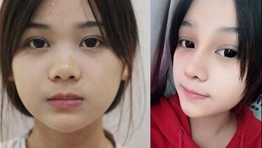 隆鼻整形前后對(duì)比圖如下