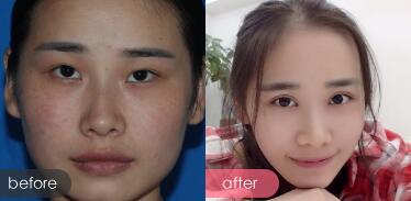 割雙眼皮前后對比圖