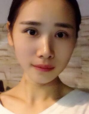 割雙眼皮恢復(fù)照片