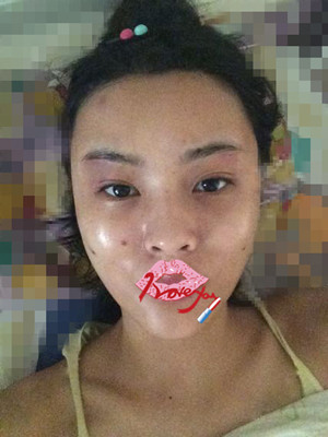 自體脂肪填充全臉，我也可以美美噠