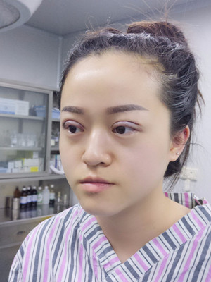 真人記錄了8周全切雙眼皮手術(shù)過程，還有對比照片喲