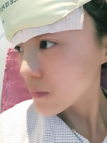 鼻子做完假體12天恢復(fù)圖