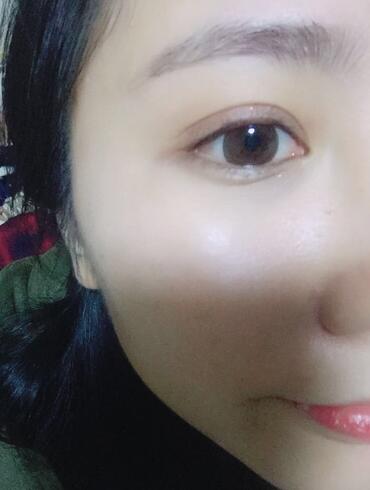 切的雙眼皮90天恢復(fù)過程圖