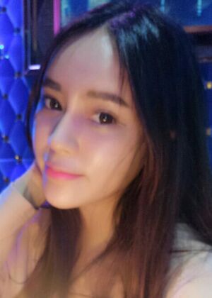 自體脂肪豐額頭+蘋(píng)果肌恢復(fù)兩個(gè)月照片分享