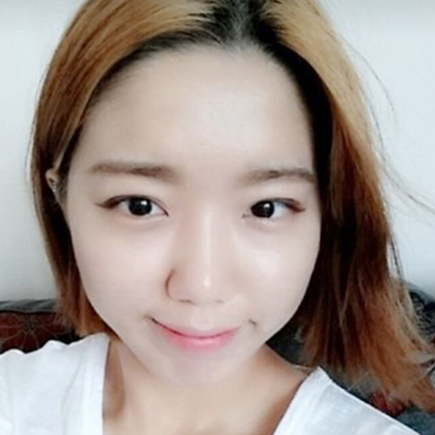 埋線雙眼皮手術(shù)兩個月了，分享術(shù)后恢復(fù)的照片呢~