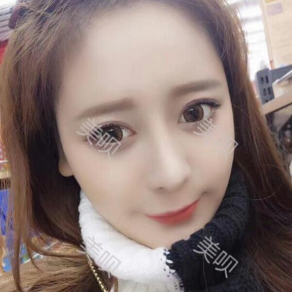 硅膠假體隆鼻+鼻翼縮小術(shù)后一個(gè)月恢復(fù)過程