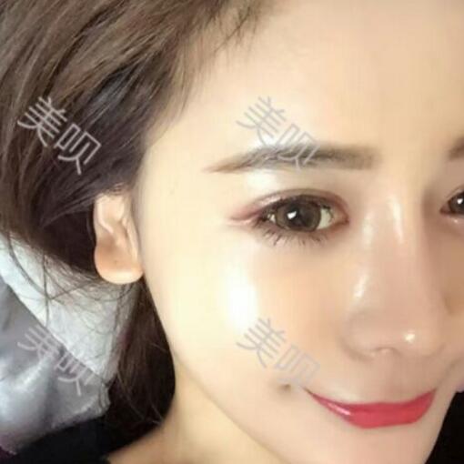 硅膠假體隆鼻+鼻翼縮小術(shù)后一個(gè)月恢復(fù)過程