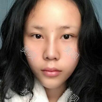 玻尿酸隆鼻前后對(duì)比照分享瞬間提升氣質(zhì)了哦