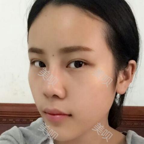 玻尿酸隆鼻前后對(duì)比照分享瞬間提升氣質(zhì)了哦