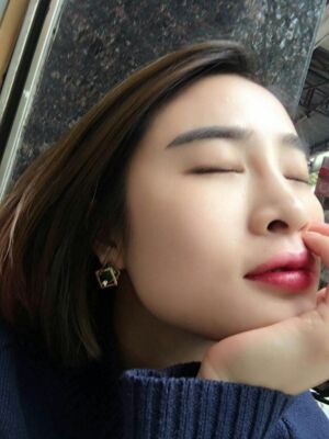 雙眼皮失敗修復(fù)之后疤痕完全沒有啦