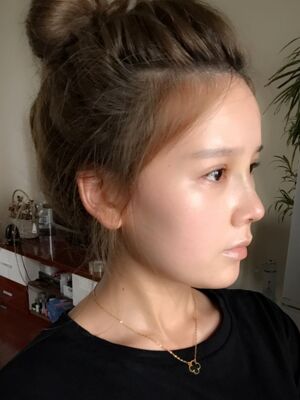 隆鼻和雙眼皮修復(fù)一起做的，現(xiàn)在氣質(zhì)提升好多