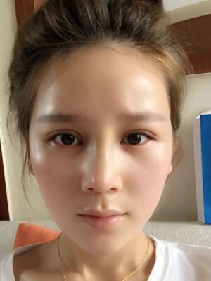 隆鼻和雙眼皮修復(fù)一起做的，現(xiàn)在氣質(zhì)提升好多