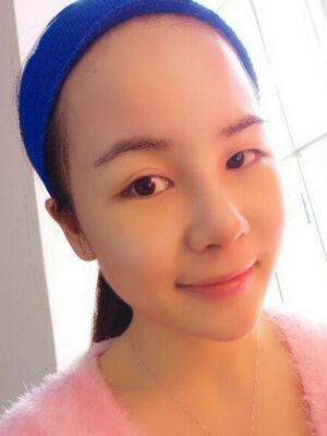 鼻部綜合整形真實(shí)案例，前后對(duì)比圖奉上