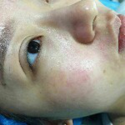 光子嫩膚快一個(gè)月了，分享手術(shù)過程和前后對(duì)比果圖片哦~