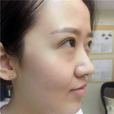 光子嫩膚快一個(gè)月了，分享手術(shù)過程和前后對(duì)比果圖片哦~