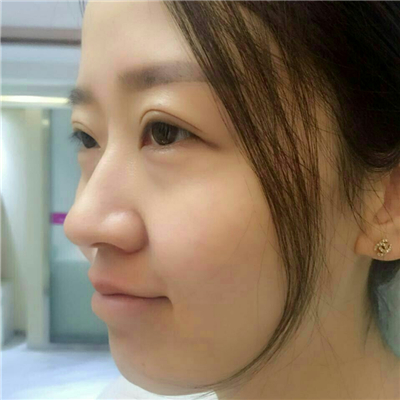 光子嫩膚快一個(gè)月了，分享手術(shù)過程和前后對(duì)比果圖片哦~