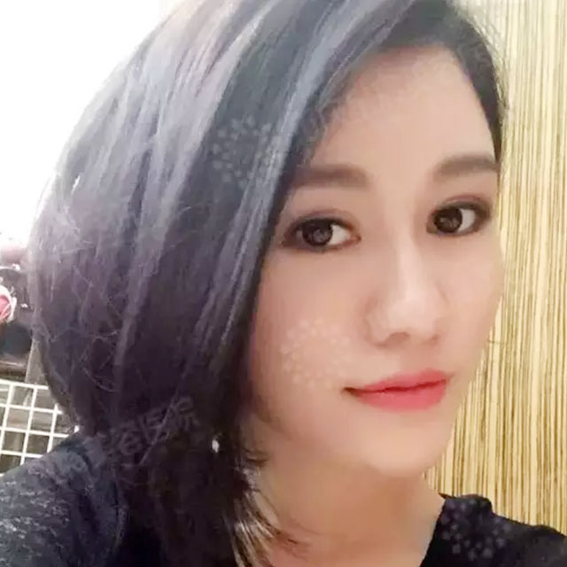 玻尿酸注射鼻子+下巴+太陽穴+蘋果肌術(shù)后一個月的果照片~