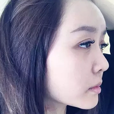 玻尿酸注射隆鼻、自體脂肪豐太陽穴跟玻尿酸墊下巴兩個月果照片~