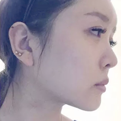 玻尿酸注射隆鼻、自體脂肪豐太陽穴跟玻尿酸墊下巴兩個月果照片~