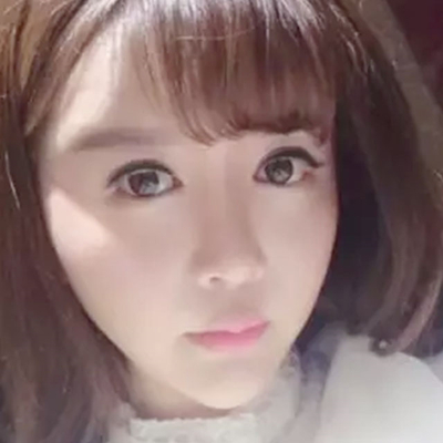 玻尿酸注射隆鼻、自體脂肪豐太陽穴跟玻尿酸墊下巴兩個月果照片~