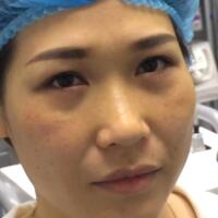 去眼袋手術(shù)多少錢？做了激光去眼袋價格5800元，恢復(fù)很好