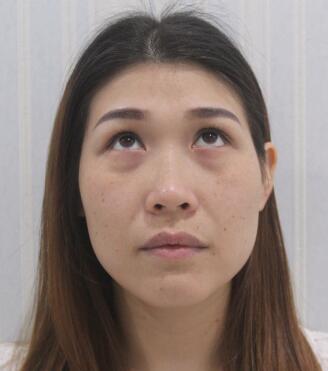 去眼袋手術(shù)前照片