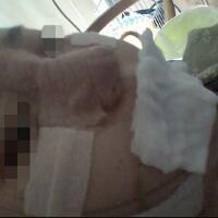 下頜骨整形價格15000元，整形前后氣質容貌變化很大