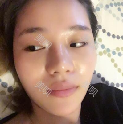 自體脂肪面部填充前后對(duì)比照的真實(shí)日記分享