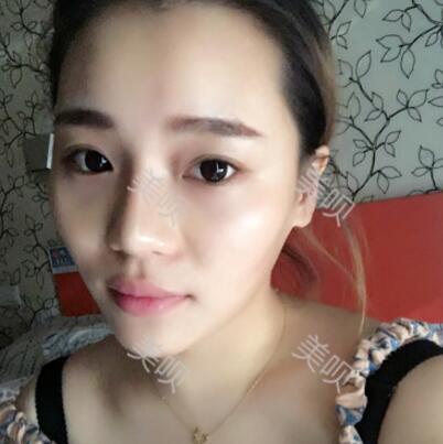 自體脂肪面部填充前后對(duì)比照的真實(shí)日記分享