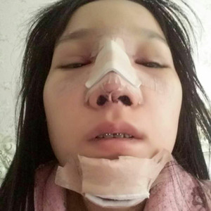 做了假體隆鼻+下巴，簡直是丑女大翻身啊