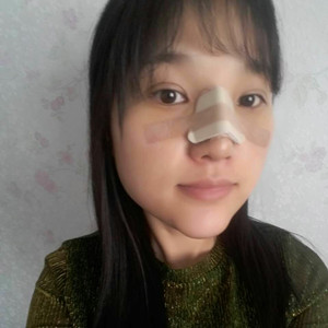 做了假體隆鼻+下巴，簡直是丑女大翻身啊