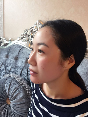 自體脂肪豐面頰，見證我蝶變的過程