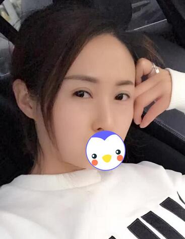 北京麗星雙眼皮修復(fù)半年了