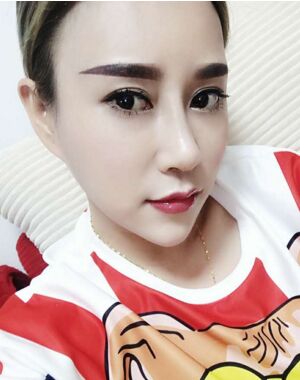 牛永敢做的隆鼻失敗修復(fù)，對(duì)比很明X哦~