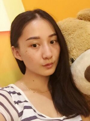 激光祛斑前后對比圖，雀斑全都沒啦