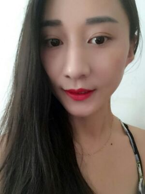 激光祛斑前后對比圖，雀斑全都沒啦