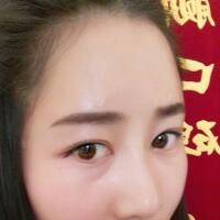 自體脂肪填充太陽穴豐額頭親身經歷，多過程恢復圖分享