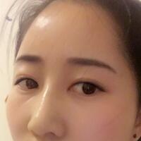 自體脂肪填充太陽穴豐額頭親身經歷，多過程恢復圖分享