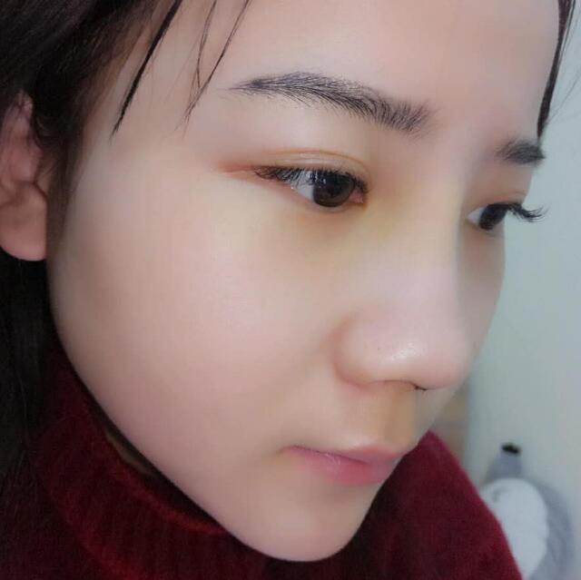 隆鼻整形前后恢復(fù)過程隆鼻梁+墊鼻尖整形果很好哦