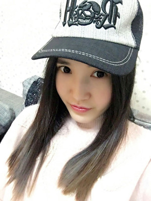 開眼角+割雙眼皮手術(shù)前后過程圖分享