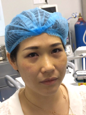 激光祛眼袋2個(gè)月，不用手術(shù)就可以變得很年輕哦！