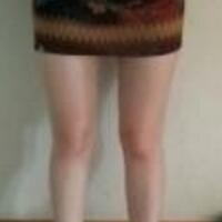 水動(dòng)力吸脂減肥瘦大腿真實(shí)經(jīng)歷，抽脂后對(duì)比照片分享