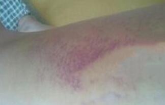 水動(dòng)力吸脂減肥瘦大腿前面一周恢復(fù)過程有些辛苦