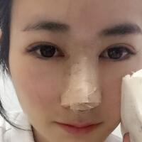 假體隆鼻圖片對(duì)比照片+鼻翼縮小親身經(jīng)歷