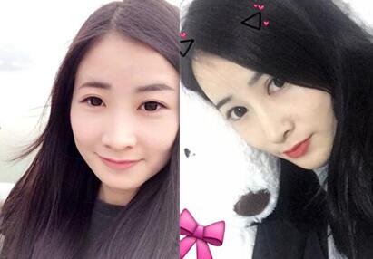 隆鼻前后的對比照片