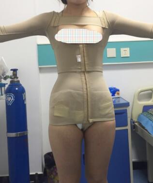 水動(dòng)力吸脂減肥手術(shù)后在醫(yī)院拍的照片