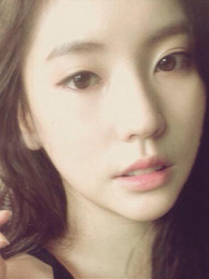 埋埋蛋白線.提升術(shù)后恢復(fù)記錄分享還有對比照